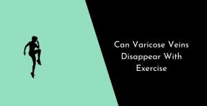 Can Varicose Veins Disappear With Exercise