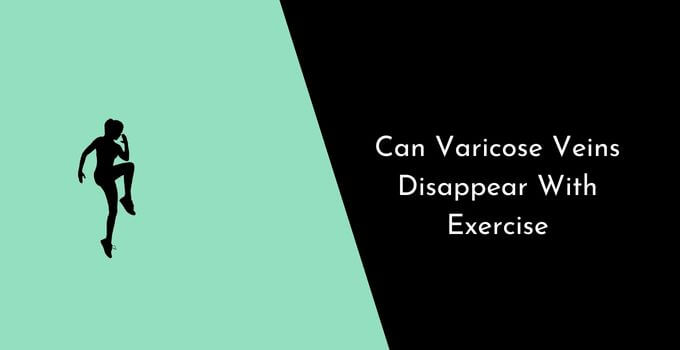 Can Varicose Veins Disappear With Exercise