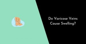 Do Varicose Veins Cause Swelling
