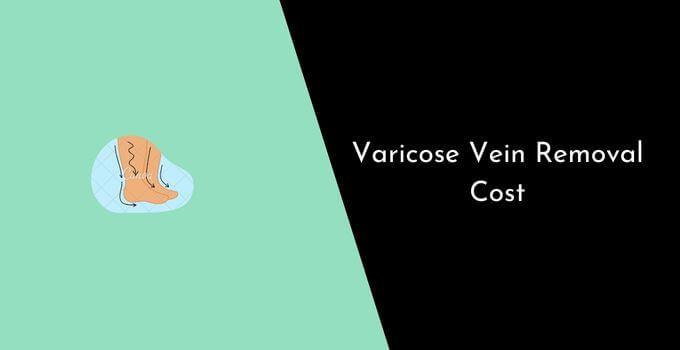 Varicose Vein Removal Cost